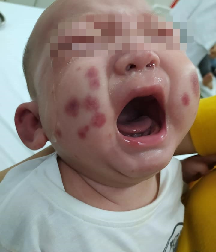 Bé trai 6 tháng tuổi ở Phú Thọ mắc bệnh siêu hiếm, chưa từng gặp tại Việt Nam - 1