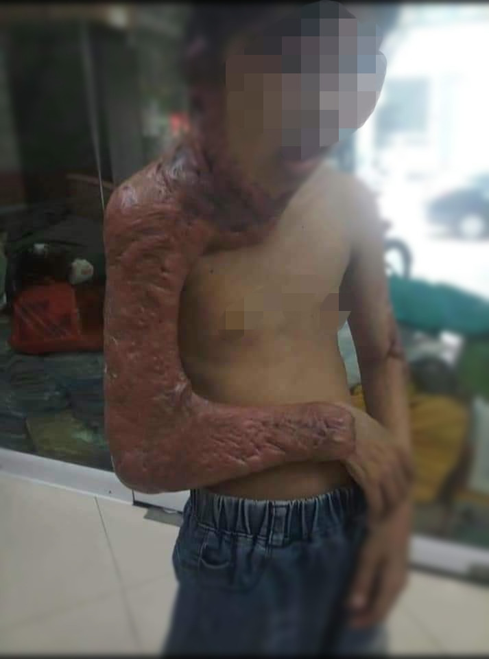 Xót xa bé 11 tuổi bị bỏng, cằm dính liền cổ, cánh tay dính chặt thân người - 3