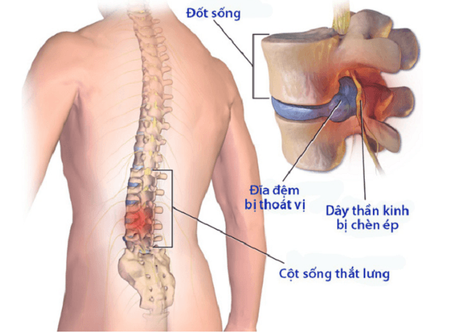 Thoát vị đĩa đệm thắt lưng: Triệu chứng, cách điều trị - 1