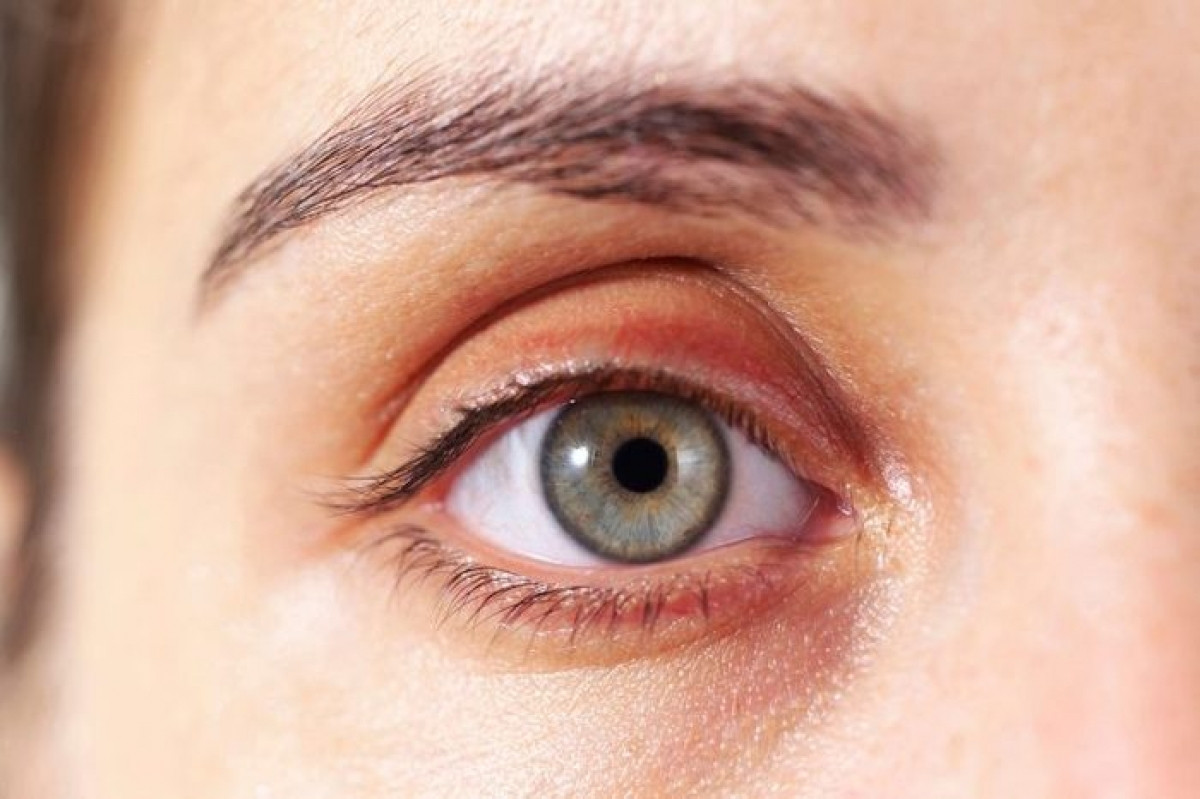 Các chấm vàng, mềm trên mí mắt: Các ban vàng mí mắt chứa đầy cholesterol này cho thấy bạn có nguy cơ mắc các bệnh tim mạch cao hơn.
