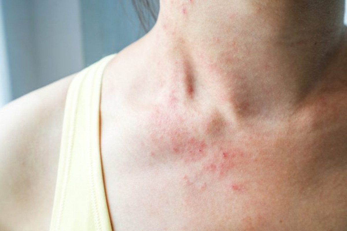 Nổi mẩn và sưng đỏ: Một số bệnh về đường tiêu hóa có thể biểu hiện trên làn da. Các cụm nổi mẩn trên da có thể là dấu hiệu của bệnh Celiac (bệnh không dung nạp gluten). Mẩn đỏ nổi thành hình cánh bướm trên má và sống mũi có thể là dấu hiệu của bệnh lupus ban đỏ.
