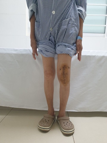 Việt Nam lần đầu mổ thay khớp gối nhân tạo cho bệnh nhân lao - 1
