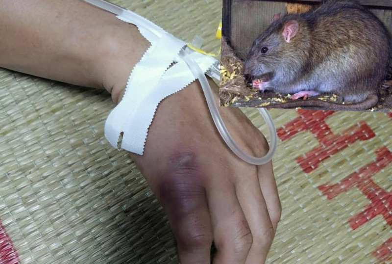 Kết quả xét nghiệm ca nghi mắc dịch hạch sau khi bị chuột cắn ở Cao Bằng - 1