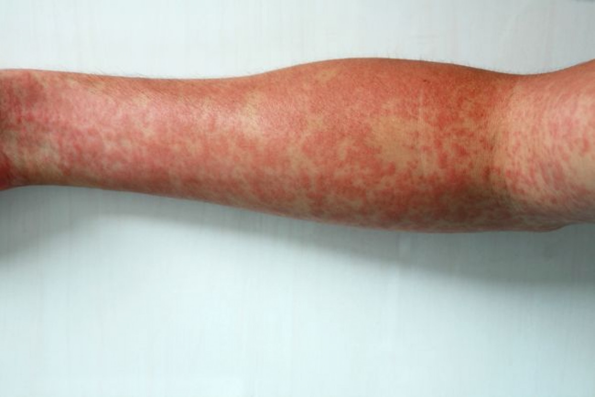 Nổi mẩn: Một triệu chứng khá phổ biến khác của sốt xuất huyết ở thể vừa là sự xuất hiện của các đốm mẩn đỏ trên da. Trong hầu hết các ca bệnh, mẩn đỏ xuất hiện trong vòng 3 - 4 ngày sau khi cơn sốt bắt đầu. Vùng mặt và vùng cổ - ngực đặc biệt dễ bị ảnh hưởng bởi triệu chứng này. Mẩn đỏ do sốt xuất huyết thường không gây ngứa.