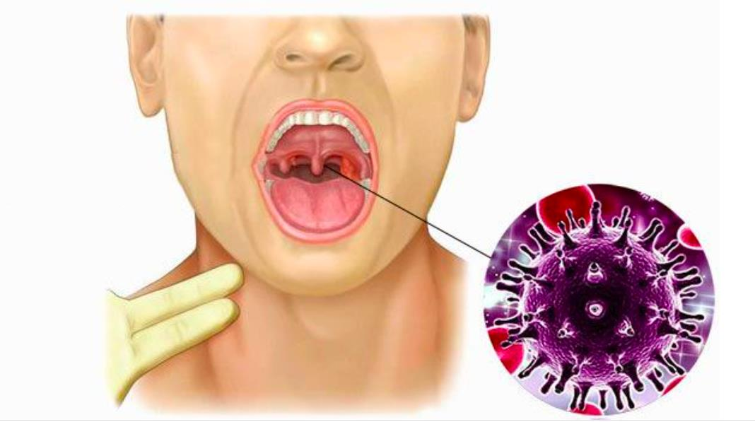 Ung thư vòm họng: Triệu chứng sớm nhất là gì, cách điều trị ra sao? - 1