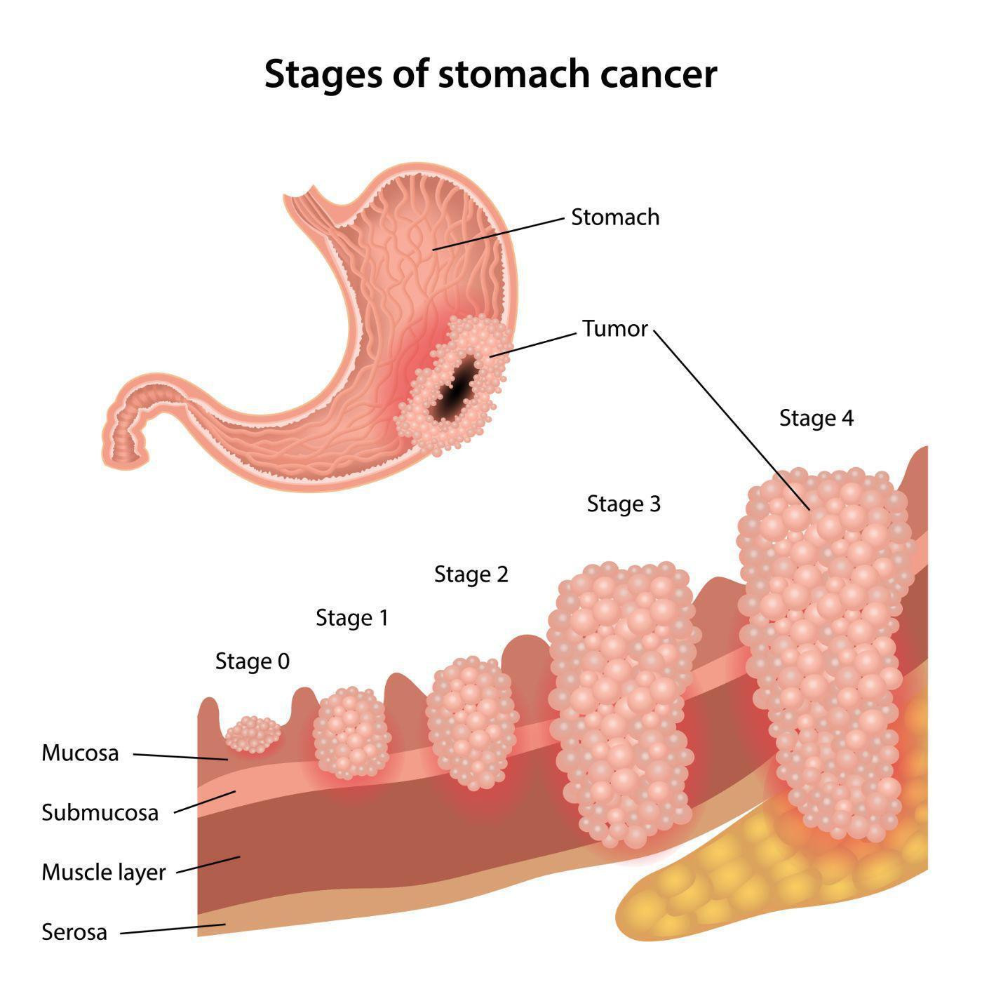 Ung thư dạ dày: 4 dấu hiệu sau khi ăn cảnh báo bệnh đã âm thầm tấn công cơ thể - 2