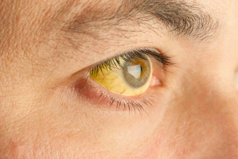 6 thay đổi sớm nhất từ đôi mắt: Dấu hiệu cảnh báo về các khối u hoặc ung thư - 1