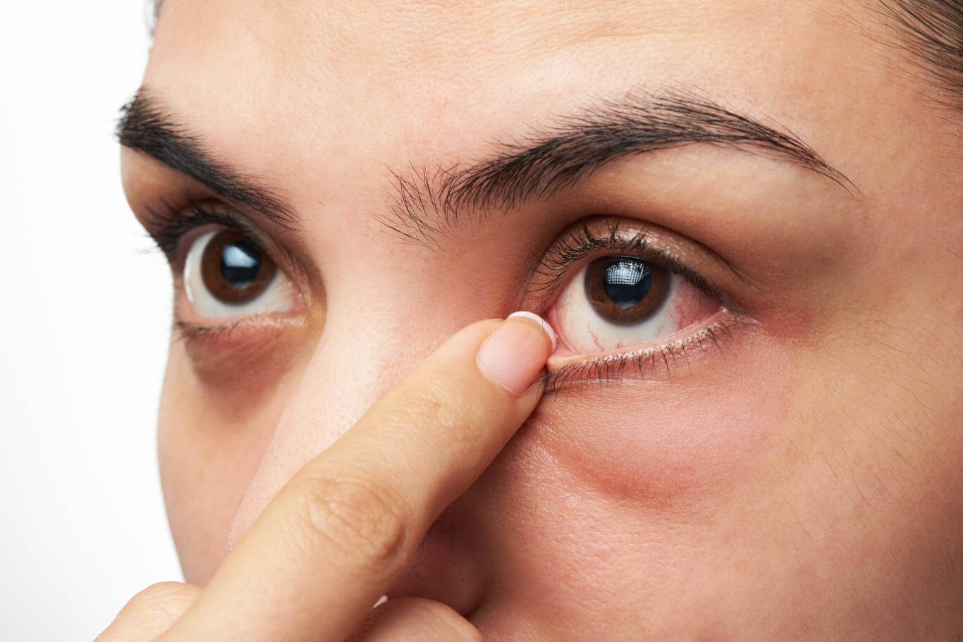 Dấu hiệu ở mắt cảnh báo bệnh tiểu đường, không chữa sớm có thể gây mù lòa - 1