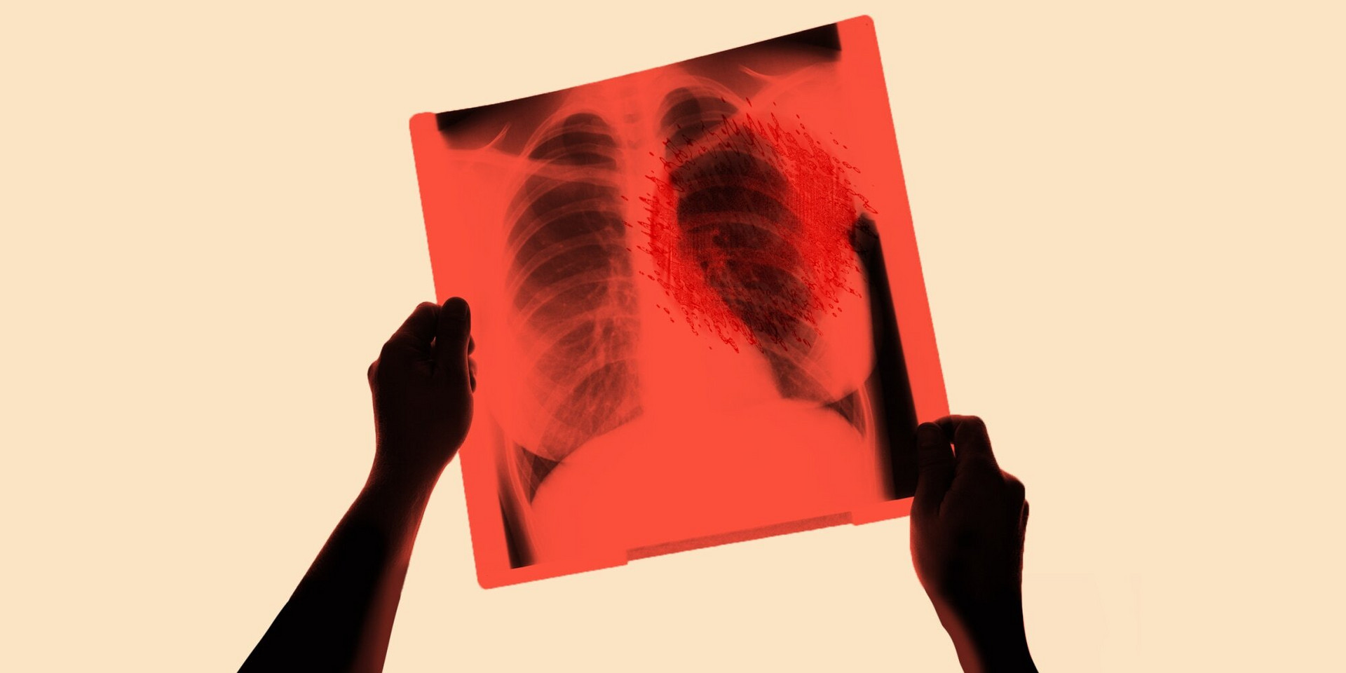Hơn 50% người bị ung thư phổi tử vong chỉ sau 1 năm: Cần làm gì để phòng ngừa? - 1