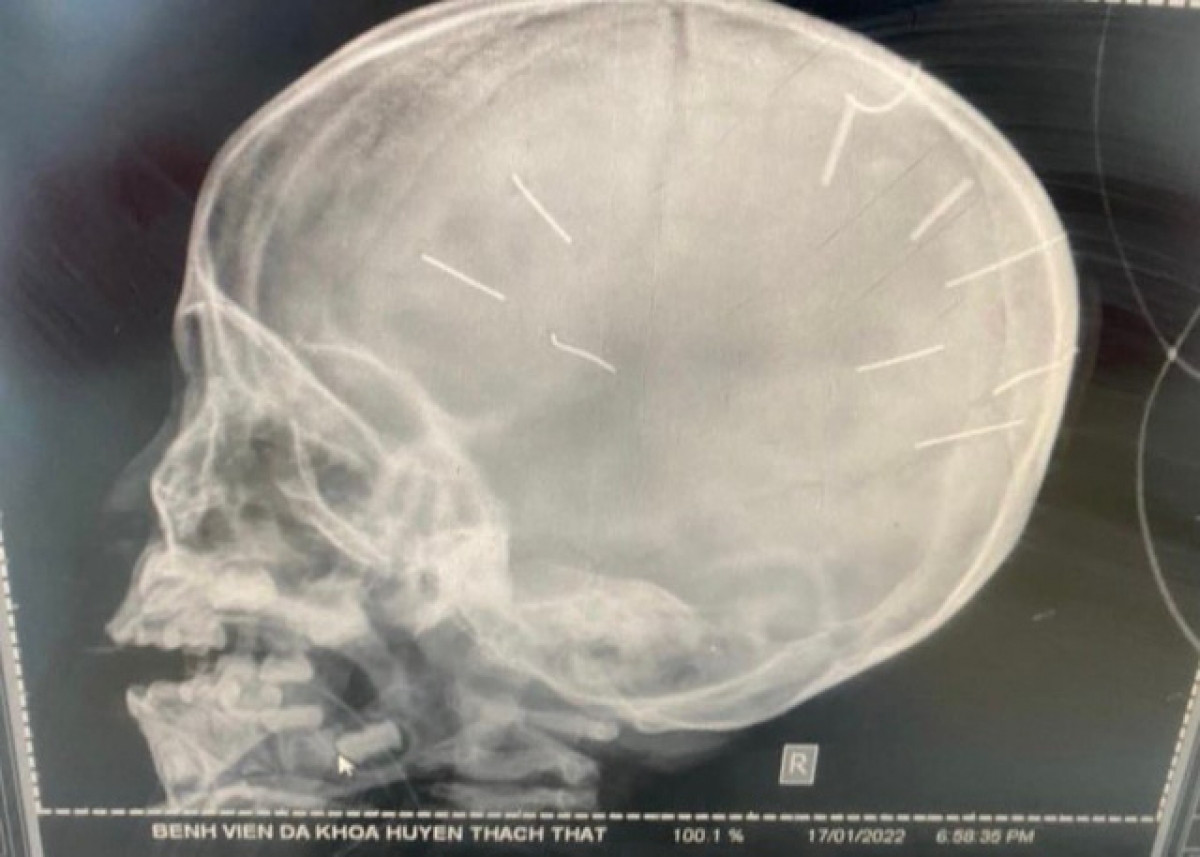 Hình ảnh chụp X-quang cho thấy cháu A. bị nhiều đinh ghim ở đầu.
