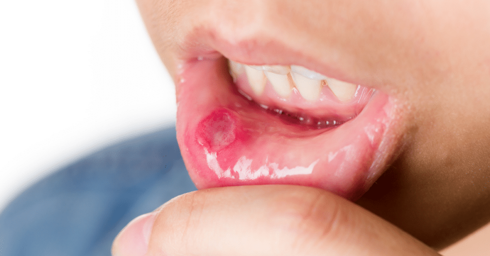 8 lý do khiến miệng luôn bị khô mỗi đêm: Tiềm ẩn nhiều bệnh nguy hiểm  - 1
