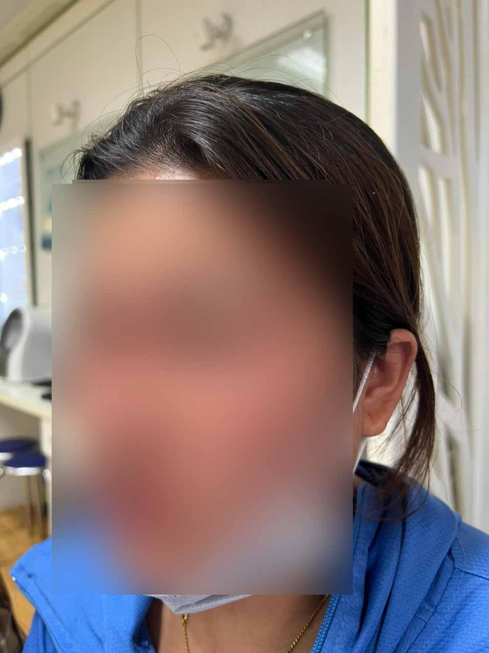 Tiêm chất làm đầy mũi để đổi vận mệnh, người phụ nữ nhập viện cấp cứu - 1