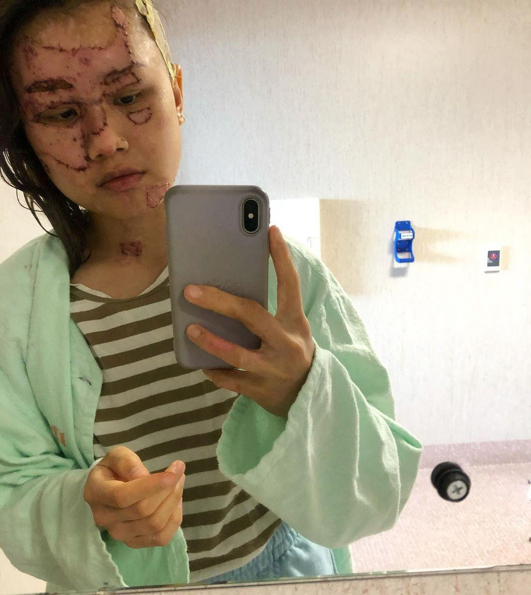 Cô gái bị hủy hoại mặt vì sơ suất từ bạn trai: Hành trình chữa lành đầy nước mắt - 3