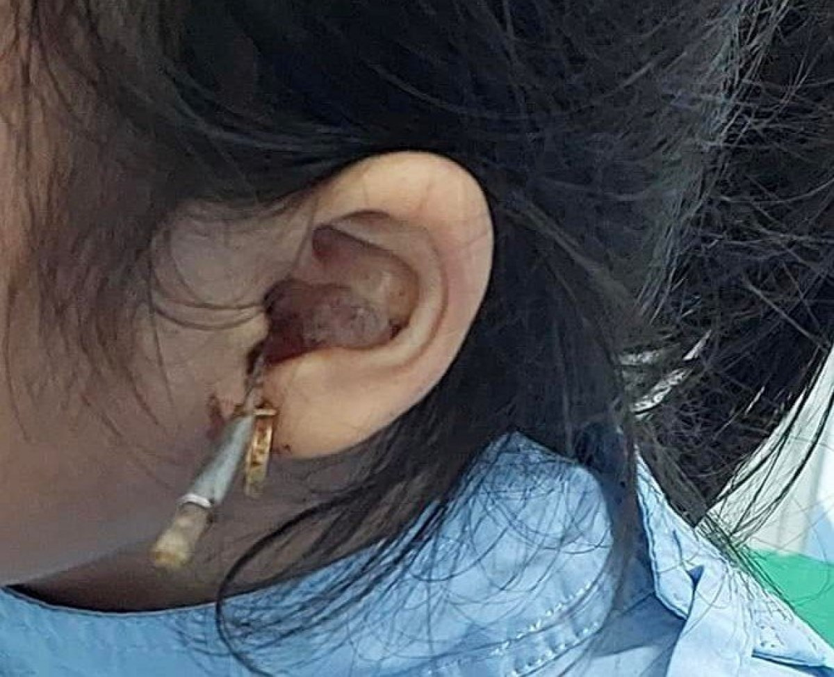 cấp cứu bé gái bị dị vật xuyên ống tai kẹt vào hòm nhĩ hình ảnh 1 cap cuu be gai bi di vat xuyen ong tai ket vao hom nhi hinh anh 1