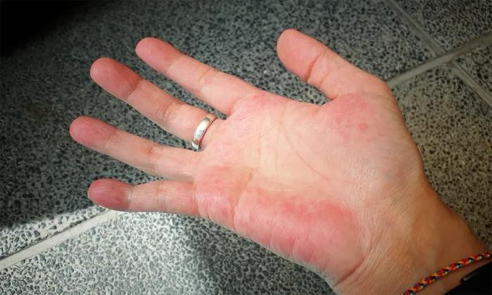Biểu hiện trên bàn tay của người mắc bệnh gan - 1