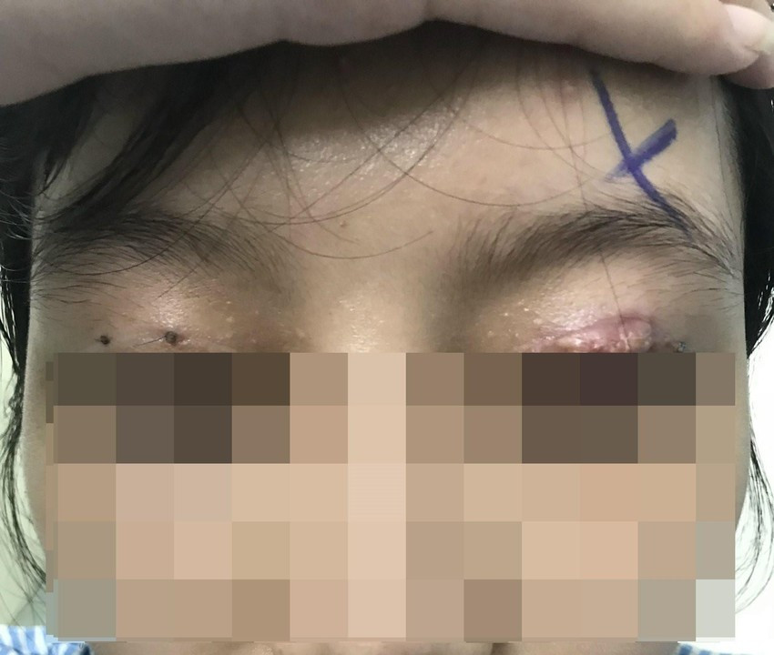Cắt mí mắt ở cơ sở thẩm mỹ 'chui', một phụ nữ bị hỏng mắt - 1