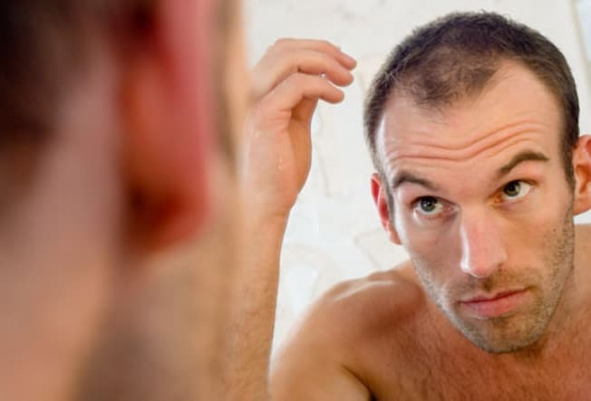 Tại sao nam giới bị rụng tóc hói đầu và có cách nào khắc phục không? -  Phòng khám Chuyên khoa Da liễu Maia&Maia
