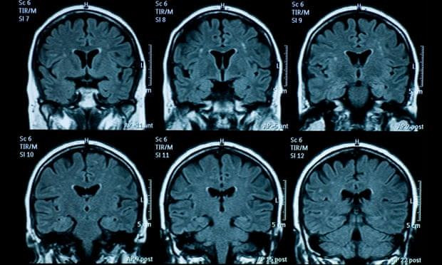 Não của thanh thiếu niên có dấu hiệu lão hóa nhanh hơn sau đại dịch COVID-19 - 1