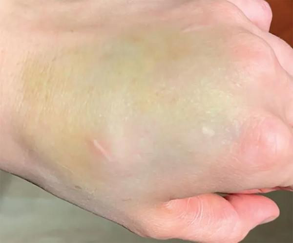Vết bầm tưởng vô hại trên tay là dấu hiệu ung thư - 1