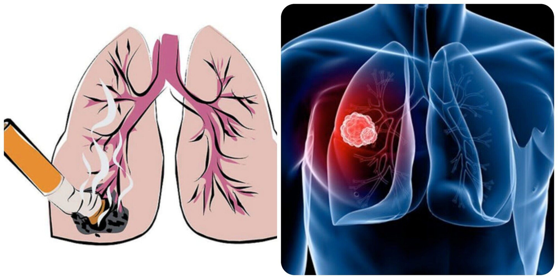 9 dấu hiệu ung thư phổi giai đoạn đầu - 1