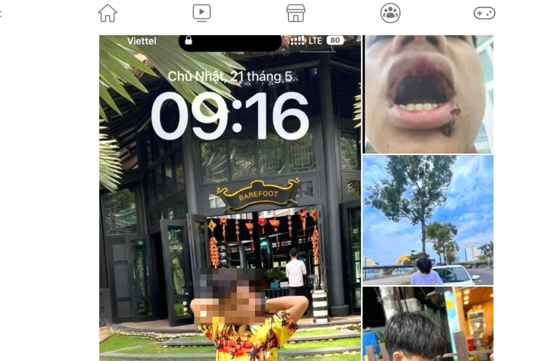 Nam sinh bị đánh gãy răng khi tắm biển ở Đà Nẵng - 1