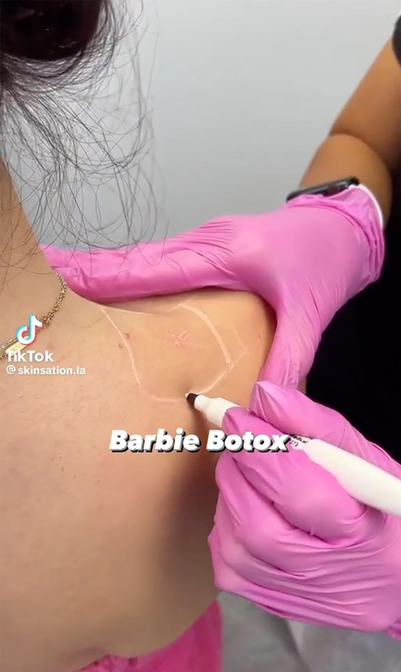Thẩm mỹ bằng phương pháp Barbie Botox có thể gây hại cho sức khoẻ. (Ảnh: TikTok)