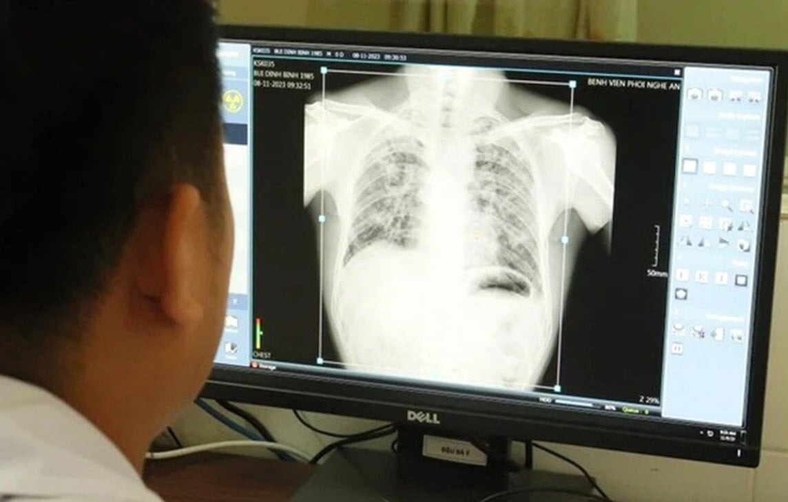 Các bác sĩ chụp phổi cho các công nhân từng làm tại Công ty TNHH Châu Tiến.