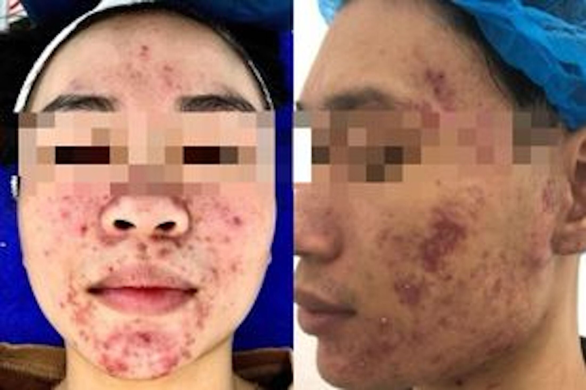 Da của Minh (bên phải) và Mai xuất hiện các ô viêm nhiễm, đầy dịch mủ sau khi sử dụng mỹ phẩm không rõ nguồn gốc. (Ảnh BSCC)