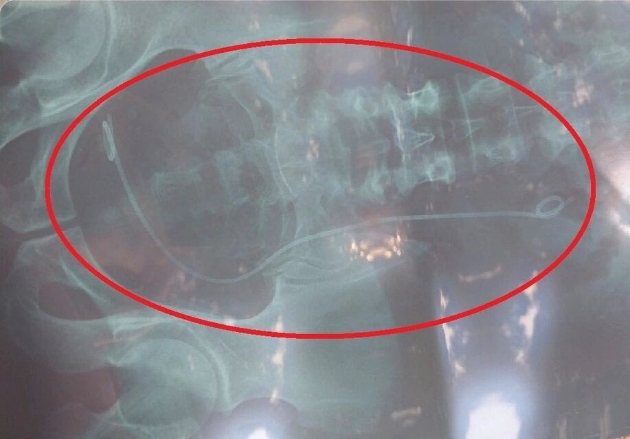 Phim X-quang có đoạn dây trong bụng bị trả nhầm cho bệnh nhân H.
