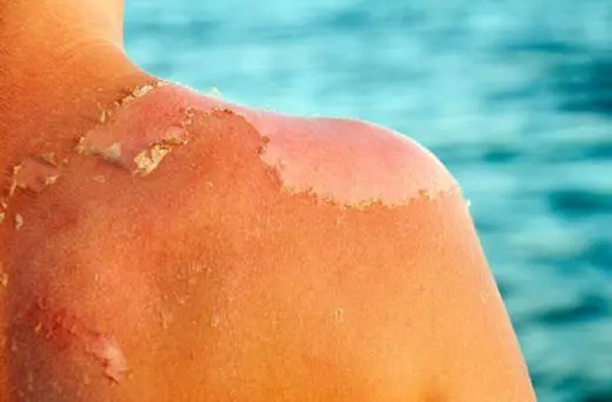 Trời nóng da dễ bị cháy nắng gây tổn thương, sạm da.
