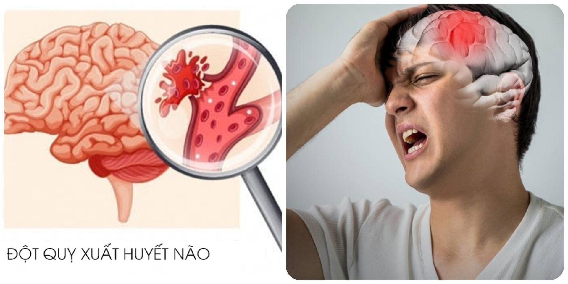 Đột quỵ não rất nguy hiểm, có thể gây ra những di chứng nặng nề, tàn phế hoặc tử vong