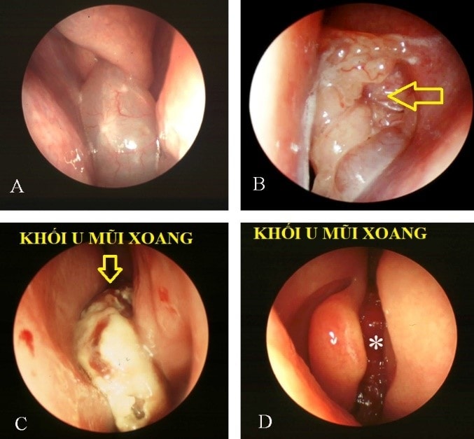 ung thu mui xoang duoc phat hien nho bieu hien dau vung ma hinh anh 1