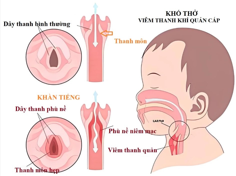 viem thanh quan o tre em trong mua lanh nhan dien, dieu tri va phong benh hinh anh 1