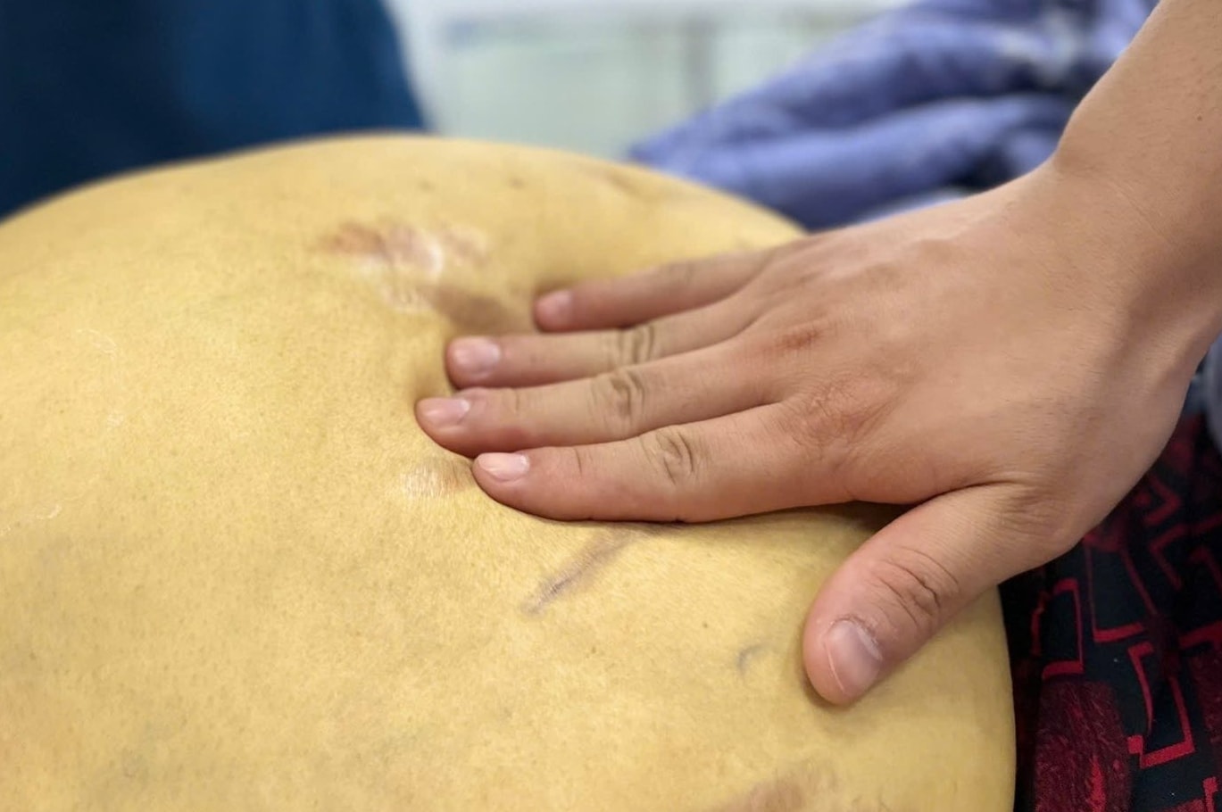 Người bệnh nhập viện trong tình trạng vàng da đậm, phù toàn thân.