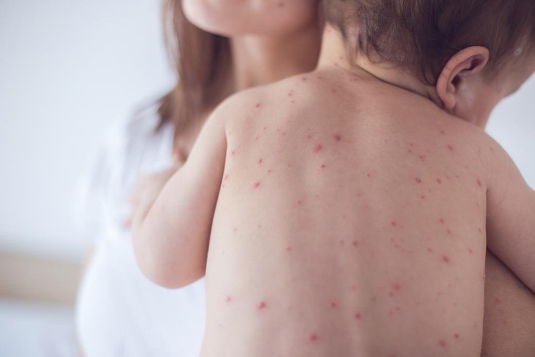 vẫn còn nhiều trẻ mắc sởi do cha mẹ chủ quan không tiêm vaccine hình ảnh 3 van con nhieu tre mac soi do cha me chu quan khong tiem vaccine hinh anh 3