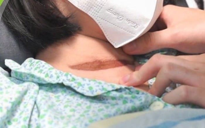 Hình ảnh vết thương trên cổ bé gái do bị cửa cuốn kẹp.