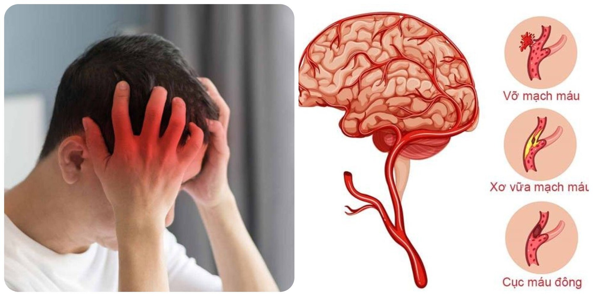Đột quỵ là nguyên nhân gây tử vong hàng đầu