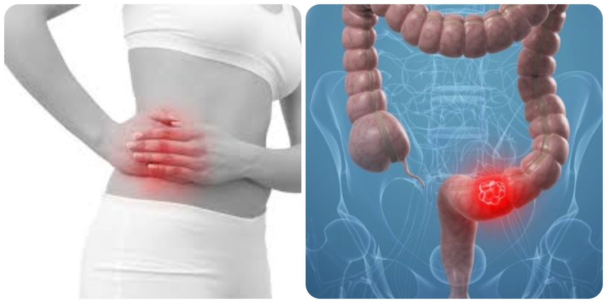 Ung thư đại tràng là một trong những căn bệnh ung thư nguy hiểm hàng đầu