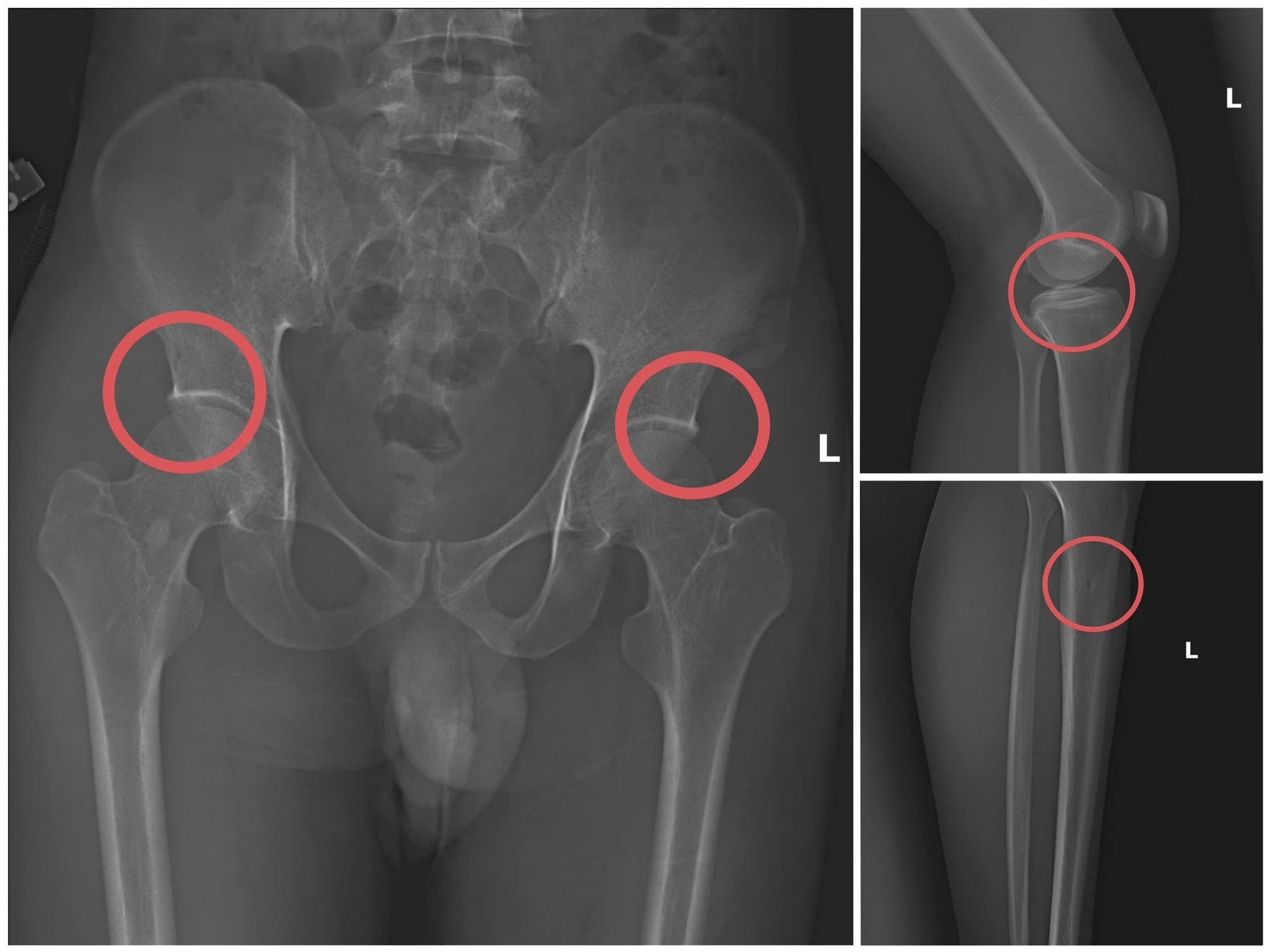 Bản phim chụp XQ một số tổn thương xương do đối tượng tạo ra nhằm trục lợi tiền bảo hiểm nhân thọ.
