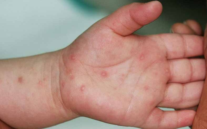 bệnh tay chân miệng số ca bệnh nặng có thể tiếp tục gia tăng hình ảnh 2 benh tay chan mieng so ca benh nang co the tiep tuc gia tang hinh anh 2