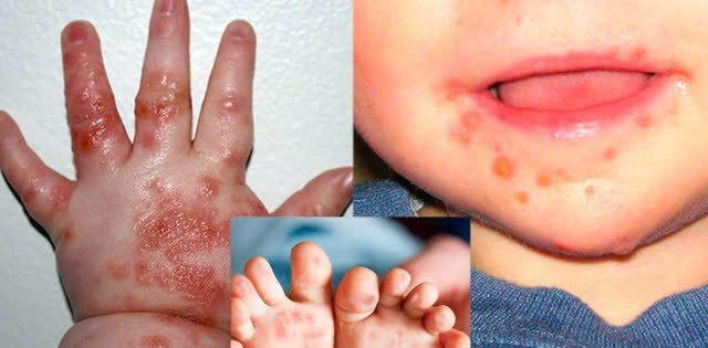 bệnh tay chân miệng số ca bệnh nặng có thể tiếp tục gia tăng hình ảnh 1 benh tay chan mieng so ca benh nang co the tiep tuc gia tang hinh anh 1
