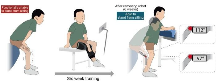 trung quốc phát triển robot đeo hỗ trợ trẻ mắc teo cơ tủy sống phục hồi vận động hình ảnh 1 trung quoc phat trien robot deo ho tro tre mac teo co tuy song phuc hoi van dong hinh anh 1