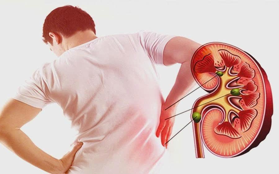 3 nhóm người có nguy cơ suy thận cao nhưng thường chủ quan hình ảnh 1 3 nhom nguoi co nguy co suy than cao nhung thuong chu quan hinh anh 1