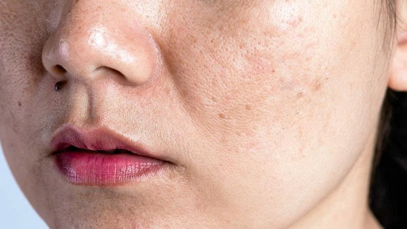 5 sai lầm mỗi ngày khiến da dễ nám hơn, nhiều chị em vẫn vô tình mắc hình ảnh 1 5 sai lam moi ngay khien da de nam hon, nhieu chi em van vo tinh mac hinh anh 1