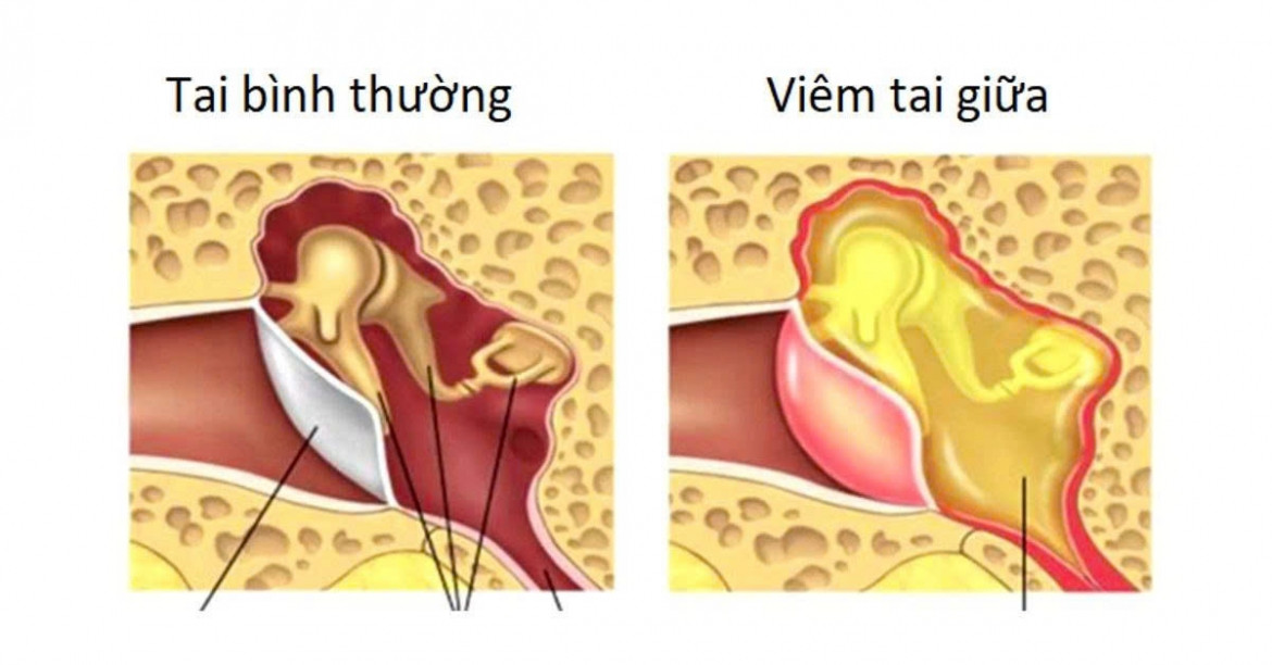 Đau tai, ù tai chớ chủ quan nhận biết 3 dạng viêm tai thường gặp hình ảnh 1 Dau tai, u tai cho chu quan nhan biet 3 dang viem tai thuong gap hinh anh 1