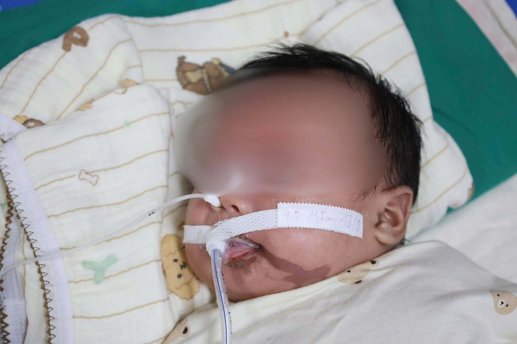 Bệnh nhi 1 tháng tuổi phải cấp cứu sau khi người thân nhỏ nhầm axit vào miệng.