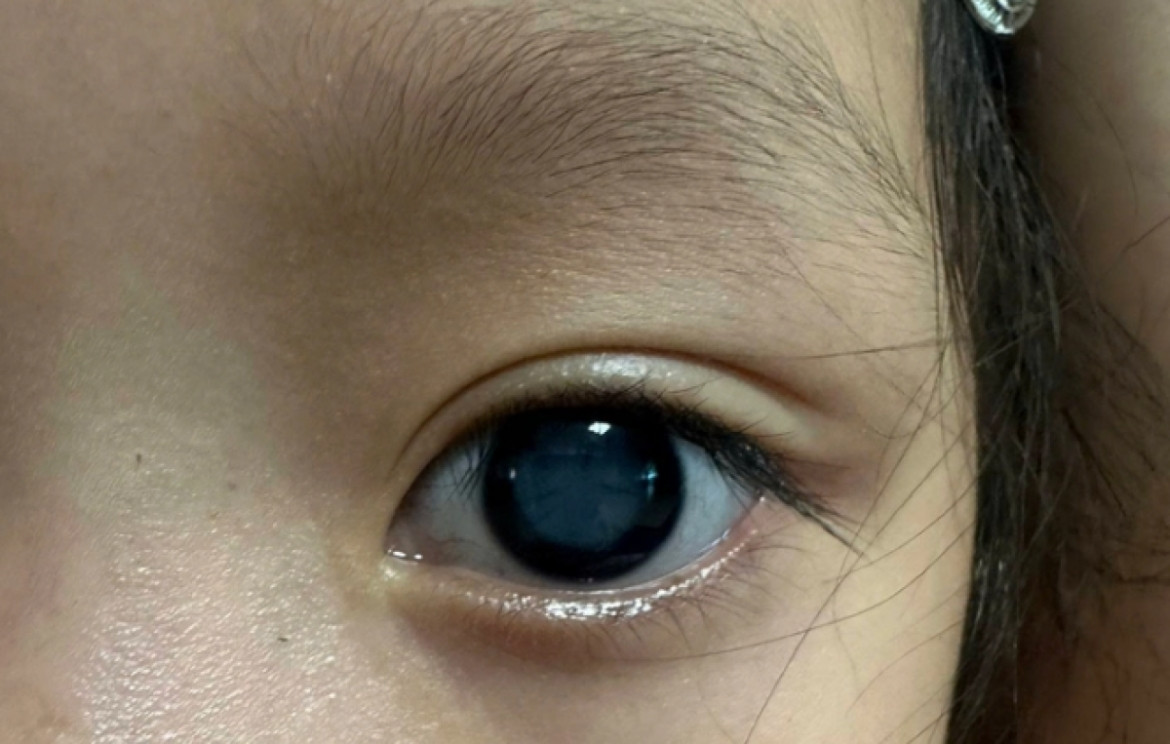 mắt con có vẻ lệch, có phải trẻ bị lác hình ảnh 2 mat con co ve lech, co phai tre bi lac hinh anh 2