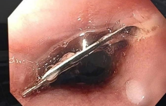 Hình ảnh dị vật qua nội soi.