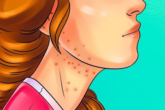 7 dấu hiệu cho thấy bạn đang ăn quá nhiều đường