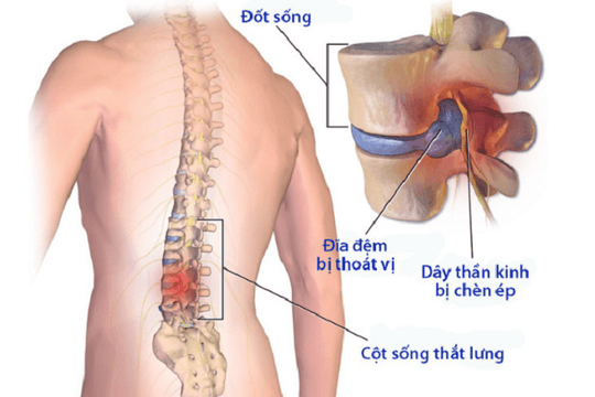 Thoát vị đĩa đệm thắt lưng: Triệu chứng, cách điều trị